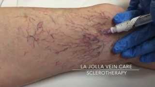 Clearing the Webs Understanding Sclerotherapy Spider Vein Injections [upl. by Annaig927]