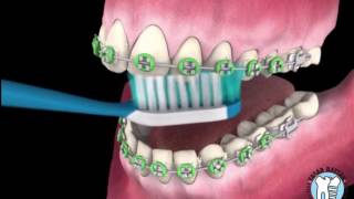 Ortodontik Diş Fırçalama Tekniği ve Diş Teli Varken Dişler Nasıl Fırçalanır [upl. by Mariand]
