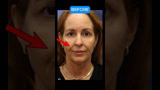 1 Year Facelift Transformation BEFORE AFTER facelift [upl. by Netfa]