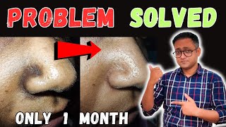 Black spots around nose  Permanent cure  Dr Supratim Saha [upl. by Aihsekin]