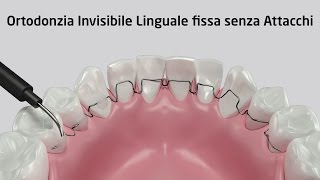 Ortodonzia Invisibile Linguale fissa senza Attacchi  Zerodonto [upl. by Stanly732]