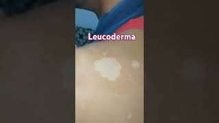 Leucoderma visit Anm herbal health and skincare clinic Lucknow 📞 9235735335 [upl. by Bent]