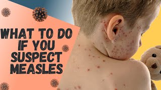 What to do if you think you or your child has MEASLES [upl. by Banerjee363]