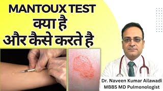 Mantoux Test क्या है और कैसे करते है  Mantoux tuberculin skin test TST TB Test  Diagnosis of TB [upl. by Sihunn]