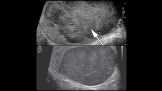 BOLITA EN EL TESTÍCULO MARCADORES TUMORALES PARA CANCER TESTICULAR [upl. by Nwahsat652]