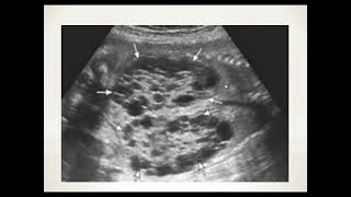 Fetal Dysplastic kidney [upl. by Geanine]