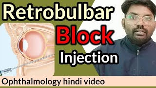 retrobulbar block injection  retrobulbar block  ophthalmologyhindi retrobulbarinjection [upl. by Ardnuhsal]