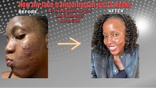 How my skin transformed in just 3 weeks of using adapalene gel and Benzoyl peroxide [upl. by Fanchon922]