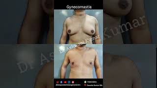 Gynecomastia surgery results day 3 [upl. by Aloisius]