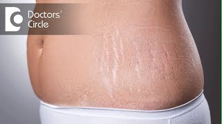 Laser treatments for stretch marks after delivery  Dr K Prem Anand [upl. by Dlanod]