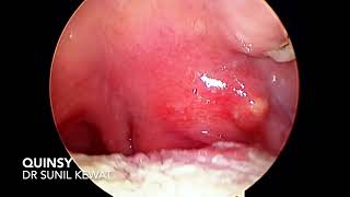 Quinsy  Peritonsillar Abscess  Dr Sunil Kewat [upl. by Ekeiram114]