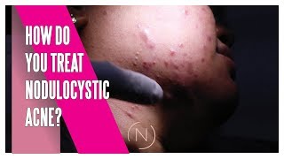 How Do You Treat Nodulocystic Acne  Houston Dermatology [upl. by Thurmond]