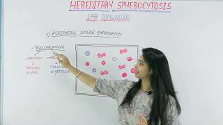 Lab Diagnosis of Hereditary Spherocytosis [upl. by Drucie]