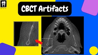 CBCT Artifacts  Basic CBCT CBCT basic understanding  Cone beam computed tomography [upl. by Aleda345]