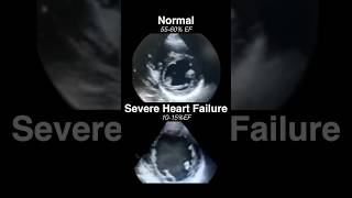 Echocardiogram NORMAL vs SEVERE HEART FAILURE radiology cardiology [upl. by Latsyrhc]