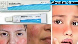 Advantan Cream Review  How to Treat Facial Rash at Home Benefits  How to Use Advantan Cream [upl. by Asilam]