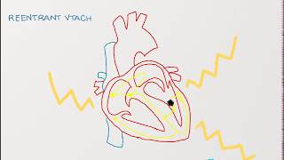 Ventricular Tachycardia  Types Causes and Treatment Approaches [upl. by Nospmas264]