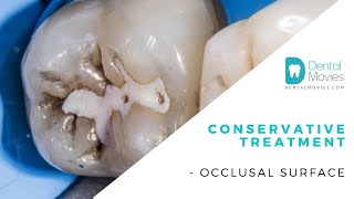 Conservative treatment occlusal surface [upl. by Hailed523]