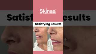 Nose Piercing at Skinaa Clinic🔥😍 shorts nostrilpiercing viral [upl. by Mera48]