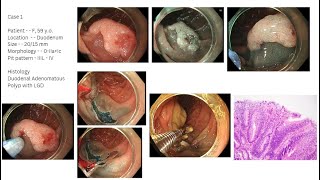 ESD and EMR of Lesion of GI Tract  Todua Clinic [upl. by Nedrob]