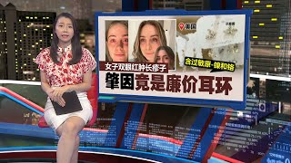 廉价首饰惹的祸 美国女子过敏半年未痊愈  新闻报报看 26072024 [upl. by Telrats]