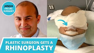 MY RHINOPLASTY JOURNEY  PLASTIC SURGEON GETS HIS NOSE DONE  DR TANVEER JANJUA  NEW JERSEY [upl. by Quickman]