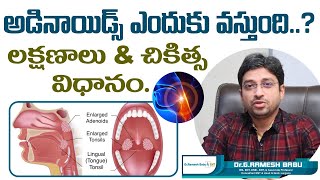 అడినాయిడ్స్ ఎందుకు వస్తుంది  Adenoids or Adenoid Hypertrophy Treatment  Dr Ramesh Babu ENT [upl. by Refennej]