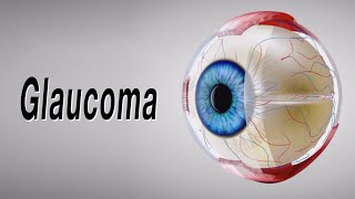 Glaucoma Animation of Why It Happens and How It Can Cause Blindness [upl. by Ttebroc]