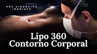 LIPO 360 DE CONTORNO CORPORAL  Cirurgia do Dia Dr Samuel Orige [upl. by Meeki]