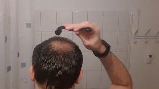 Minoxidil  Derma Roller Results I 4 Months Update [upl. by Taite]