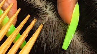 ASMR Rare amp Specific NITPICKING  ATTENTIVE Scalp Inspection triggers 😴 [upl. by Manny]