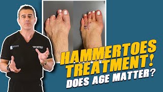 Failed Surgeries FIXED 60Second HammerToe Repair 😮 [upl. by Essilevi]