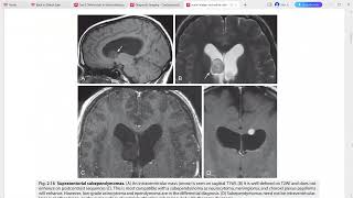 CORE REQUISITES of neuroradiology [upl. by Persian]