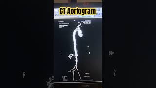 Ct Aortogram  Angioof Aorta medicos1k86 radiology ct anatomy neet trendingshortsviralxray [upl. by Nyledaj930]