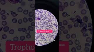 MP slide Plasmodium vivax on oil immersion 100× laboratory hematology [upl. by Wanyen131]