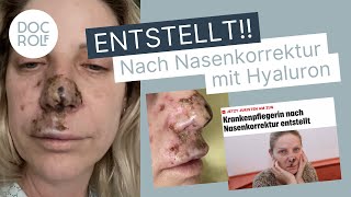 NASENKORREKTUR OHNE OP – Wienerin entstellt 😱 – Dr Rolf Bartsch [upl. by Eniretac]