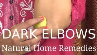 Dark Elbows  Natural Home Remedies [upl. by Nylitak]