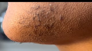 INGROWN HAIR REMOVAL 104  Plucking the hairs on my chinny chin chin [upl. by Walling]