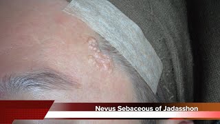 Nevus Sebaceous of Jadasshon on Face Removal Surgery HD 피지샘모반 야다손씨피지선모반 제거 수술 수원 광교 유디트 성형외과 닥터랜사부 [upl. by Balcke428]