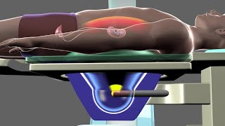 Shockwave Lithotripsy [upl. by Carlos]