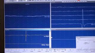 EMG JVC Fasciculaciones [upl. by Phillips]