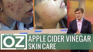 The Latest Apple Cider Vinegar Trend [upl. by Bain]