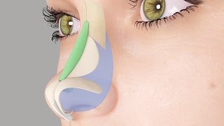 Saddle Nose or Ski Slope Nose Rhinoplasty Nosejob [upl. by Akiem]