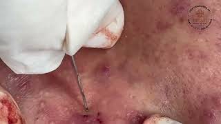 Satisfying Relaxing with Vien Tham My DrAZI vienthammydrazi0148 acne pimples blackheads [upl. by Ermey]