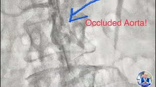 Occluded Aorta infrarenal CTO Revascularization of Aorta and Iliac artery  Lithotripsy amp stent [upl. by Anallise628]