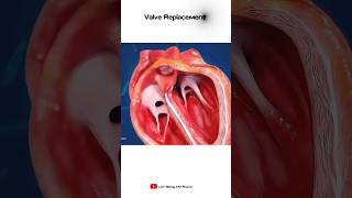 Heart Valve Replacement  Short animation [upl. by Danas79]