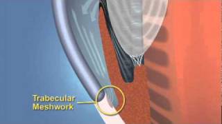 Closed Angle Glaucoma [upl. by Manus181]