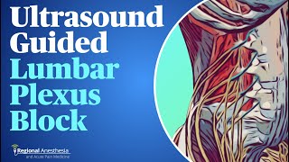 UltrasoundGuided Lumbar Plexus Block [upl. by Leanatan]