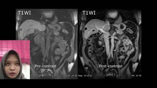 Agent contrast Gadolinium in MRI [upl. by Lenuahs283]