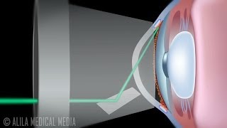 Laser Trabeculoplasty for Glaucoma ALT vs SLT Animation [upl. by Alimhaj]